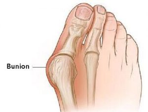 treat bunions without surgery