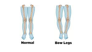 cure bow legs